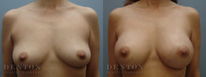 Breast Augmentation B&A 8A