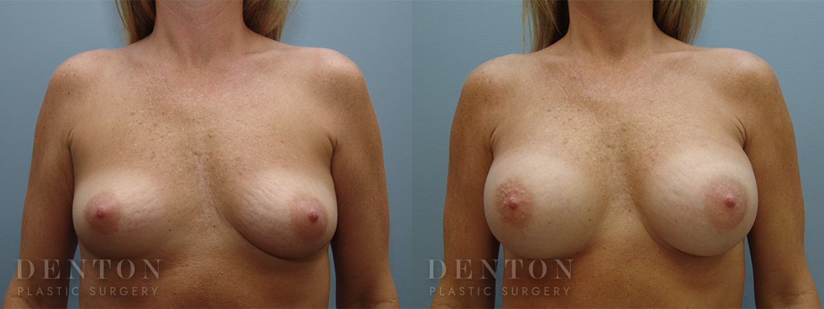 Breast Augmentation B&A 9A