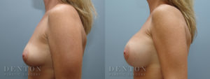Breast Augmentation B&A 9C
