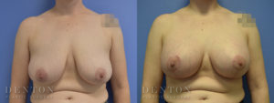 Breast Lift w/ Implants B&A 3A