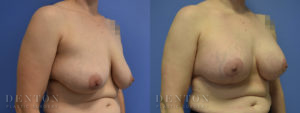 Breast Lift w/ Implants B&A 3B