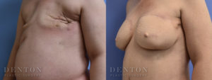 Breast Reconstruction B&A 3B