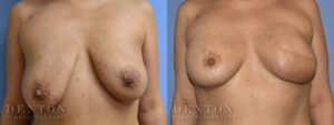 Breast Reconstruction B&A 1A