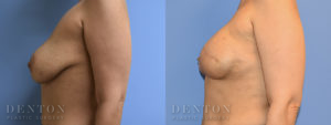Implant-Based Reconstruction Patient 1-C: Before & After
