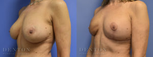 Breast Reconstruction B&A 3B