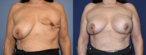 Breast Reconstruction B&A 4A