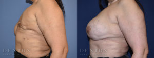 Breast Reconstruction B&A 4C