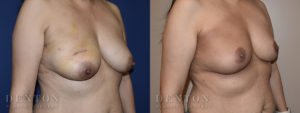 Breast Reconstruction B&A 1B