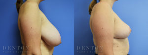 Breast Reduction Patient 1-C: Before & After