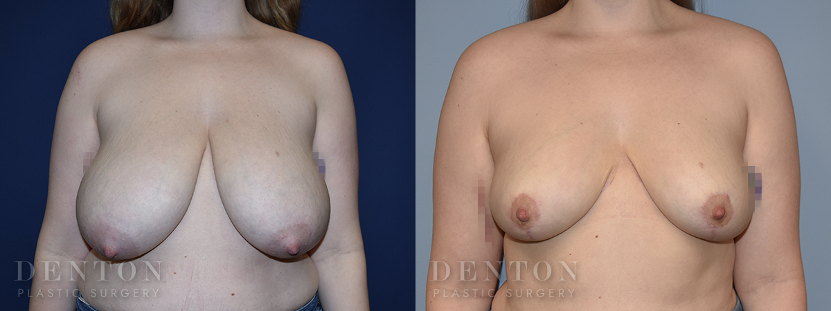 Breast Reduction B&A 3A