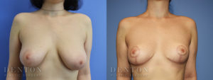 Breast Reduction B&A 4A