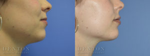 Lip Augmentation Revision Patient 1-C: Before & After