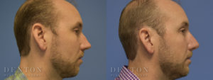 Septoplasty Patient 1-C: Before & After