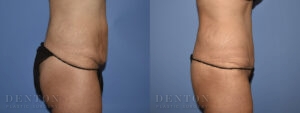 Tummy Tuck Patient 09A
