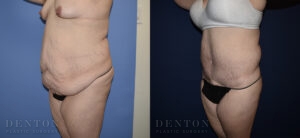Body Lift Patient 3-A: Before & After