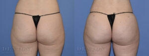 Brazilian Butt Lift Patient 3-A: Before & After