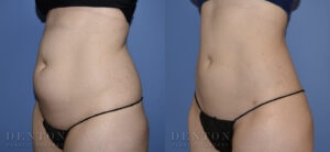 Liposuction B&A Patient 1D