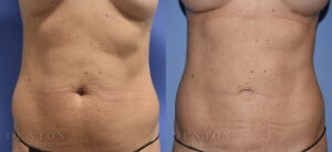 Liposuction B&A Patient 02C