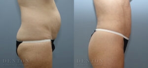 Liposuction Patient 3-A: Before & After