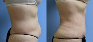 Liposuction B&A 5B