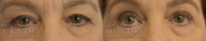 Blepharoplasty B&A 1A