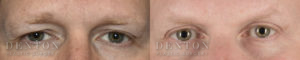 Blepharoplasty B&A 3A