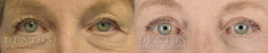 Blepharoplasty B&A 4A