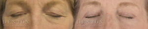 Blepharoplasty B&A 4B