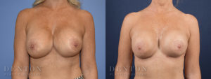Breast Augmentation Revision B&A 1A