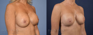 Breast Augmentation B&A 1B