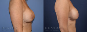 Breast Revision Surgery Patient 1-C: Before & After