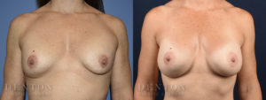 Brest Augmentation Revision B&A 2A