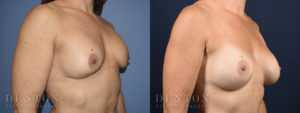 Breast Augmentation Revision B&A 2B