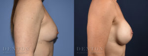 Breast Augmentation Revision B&A 2C