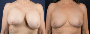 Breast Augmentation Revision B&A 3A