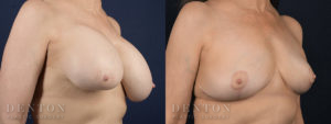 Breast Augmentation Revision B&A 3B