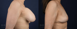 Breast Augmentation Revision B&A 3C