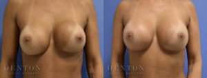 Breast Augmentation Revision B&A 4A