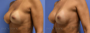 Breast Augmentation Revision B&A 4B