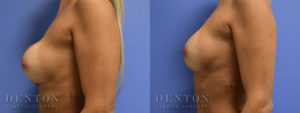 Breast Augmentation Revision B&A 4C