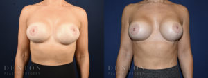 Breast Augmentation Revision B&A 5A