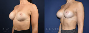 Breast Augmentation Revision B&A 5B