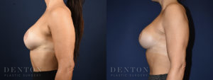 Breast Augmentation Revision B&A 5C