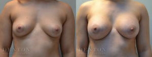 Breast Augmentation B&A 1A