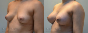 Breast Augmentation B&A 1B