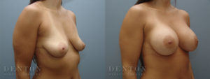 Breast Augmentation B&A 10B