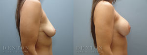 Breast Augmentation B&A 10C