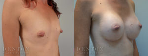 Breast Augmentation B&A 11B