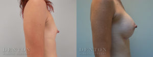 Breast Augmentation B&A 11C