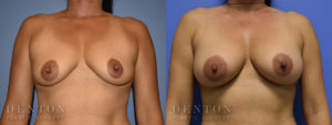 Breast Augmentation B&A 12A